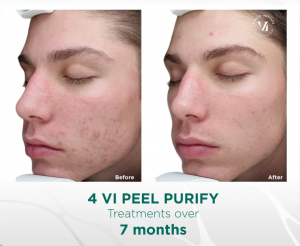 Acne Treatments at Revive for clear healthy skin