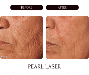 Laser treatments Laser Treatment Pearl Laser
