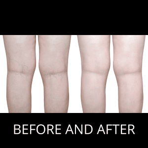 Spider Vein Treatment