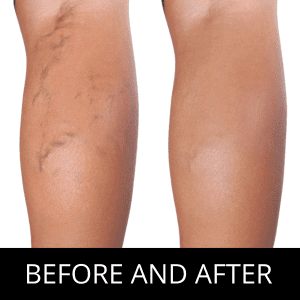 Spider Vein Treatments