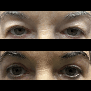 Blepharoplasty eyelid surgery skin laxity