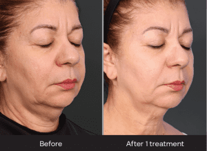 Xerf Before and After 1