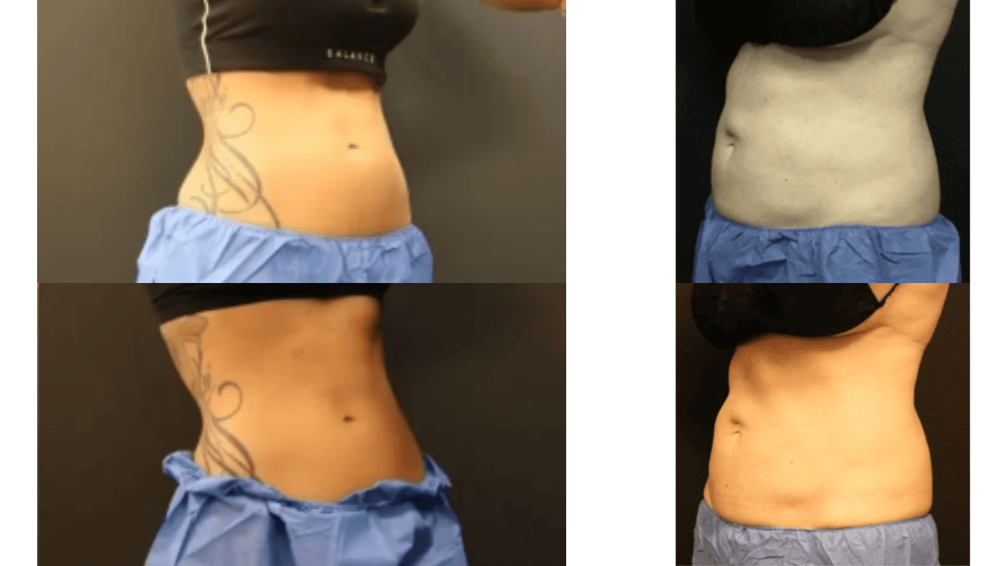 Emsculpt Before and After Revive Medical Spa