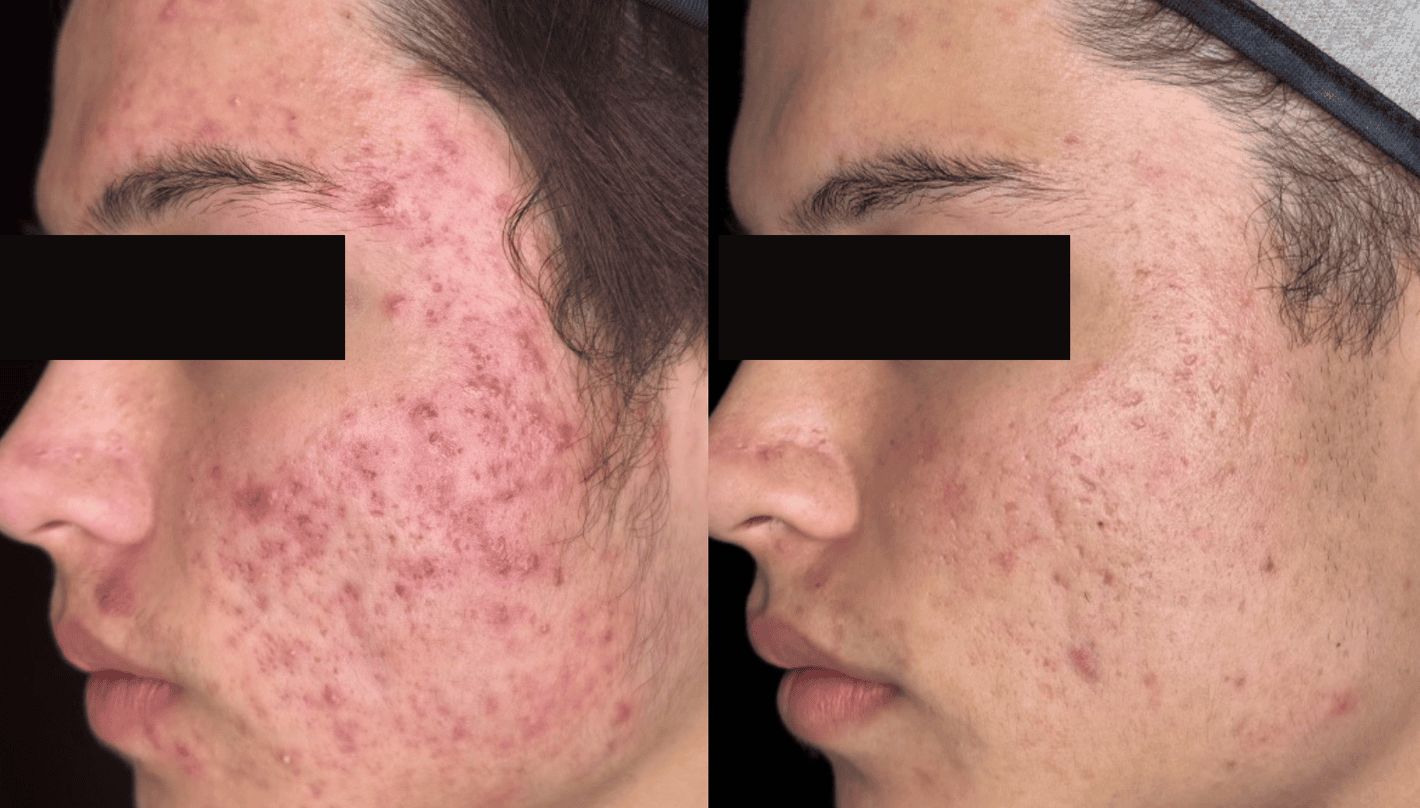 AviClear Acne Treatment Before and After Revive Medical Spa Fayetteville