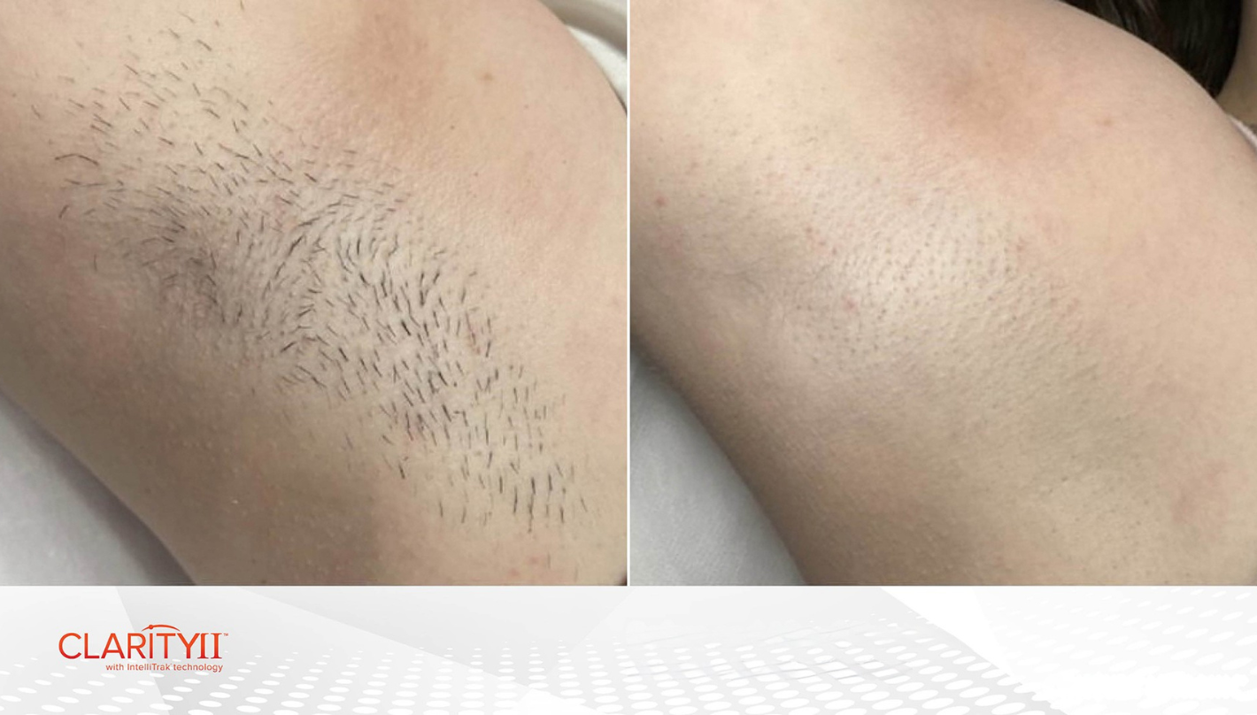 Laser Hair Removal Before and After Revive Medical Spa Fayetteville Rogers