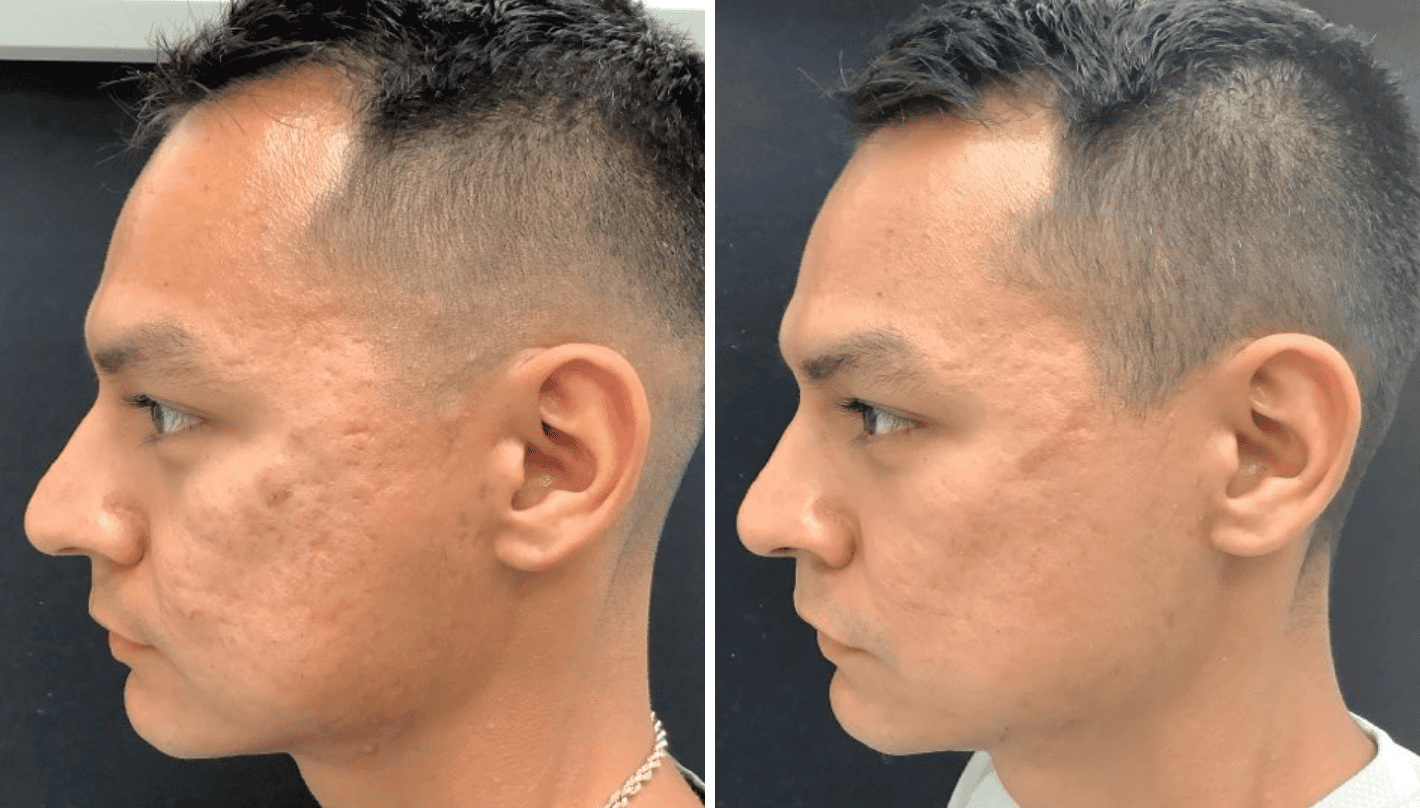 SkinPen Microneedling Before and After Revive Medical Spa