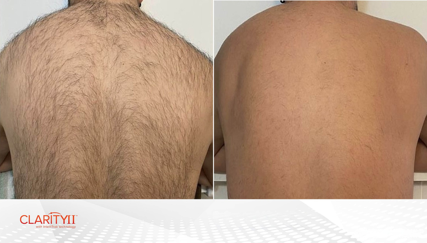 Laser Hair Removal Before and After Revive Medical Spa Fayetteville Rogers