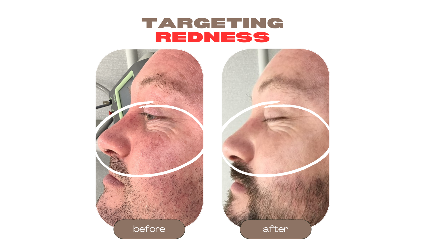 Limelight IPL Before and After Revive Medical Spa Fayetteville Rogers