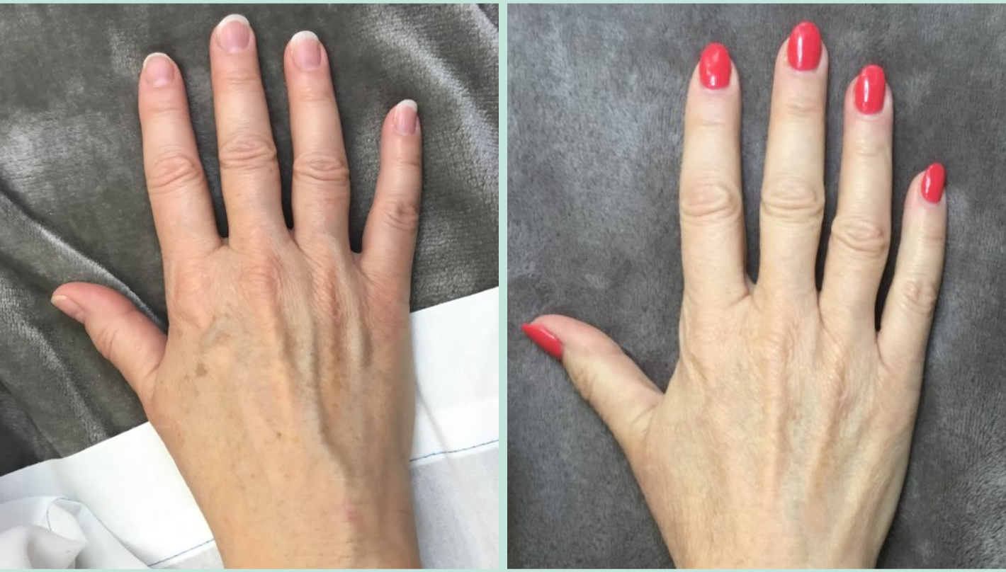 Limelight IPL Before and After Revive Medical Spa Fayetteville Rogers