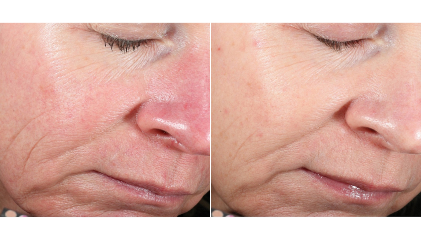 DermaV Before and After Revive Medical Spa Fayetteville