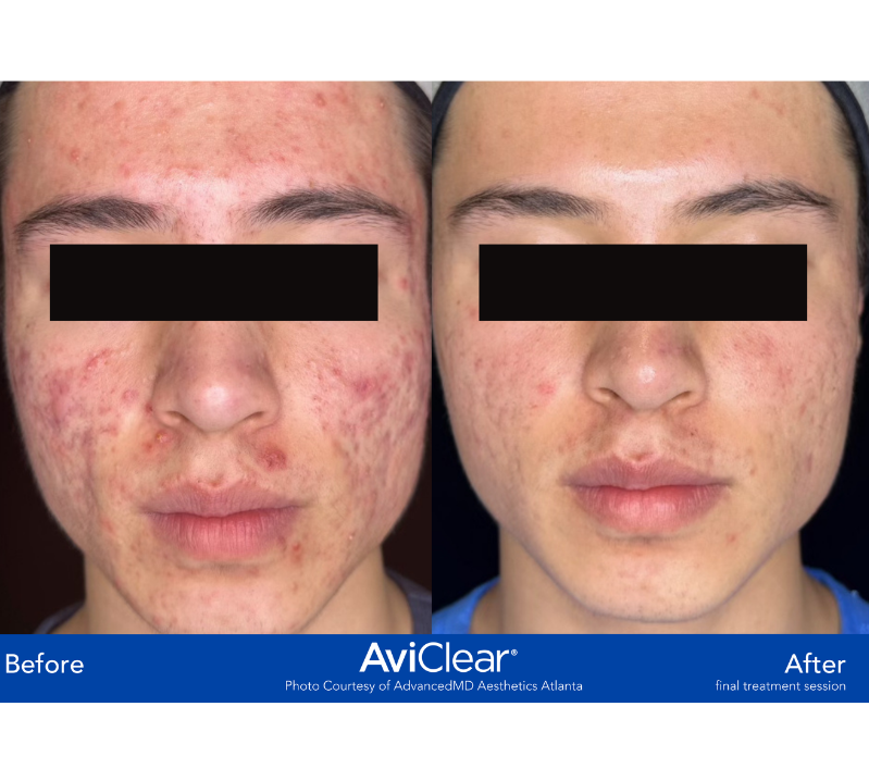 Acne Laser treatment AviClear Revive Medical Spa