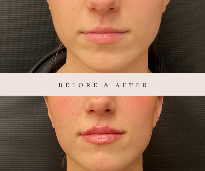 Lip Filler Before and After Injectables Filler Revive Medical Spa