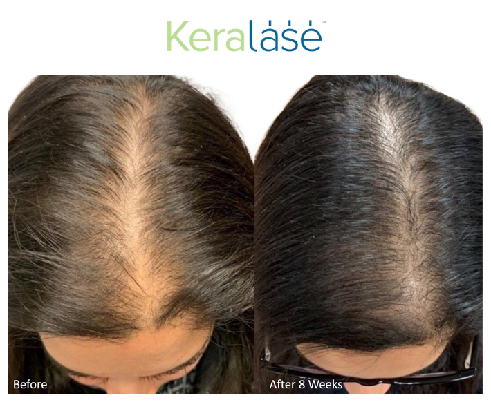 Keralase Lutronic Before and After Revive Medical Spa Hair Thinning Fayetteville Rogers Harrison
