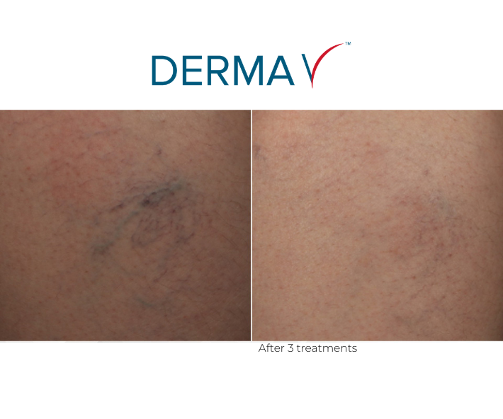 DermaV Vascular Spider Veins Before and After Revive Medical Spa Fayetteville