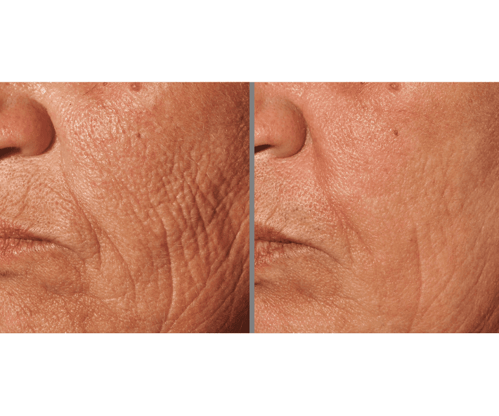 Pearl Fractional Before and After Revive Medical Spa Fayetteville