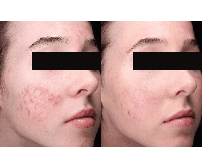 AviClear Acne Treatment Before and After Revive Medical Spa Fayetteville