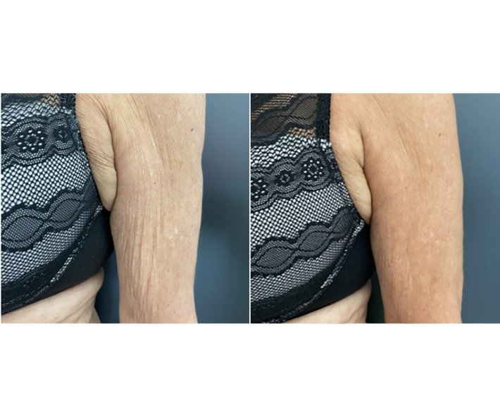 Genius RF Microneedling Before and After Revive Medical Spa Fayetteville Rogers