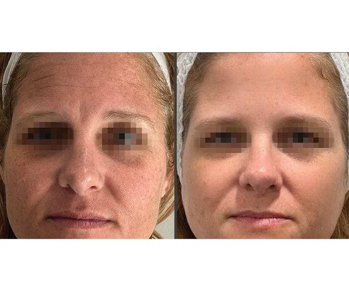 Ultra RF Before and After Revive Medical Spa Fayetteville Rogers