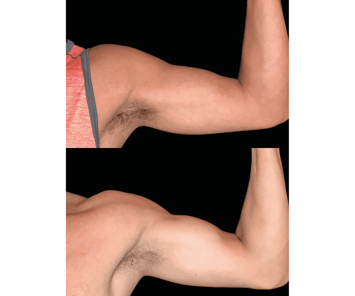 Emsculpt Before and After Revive Medical Spa