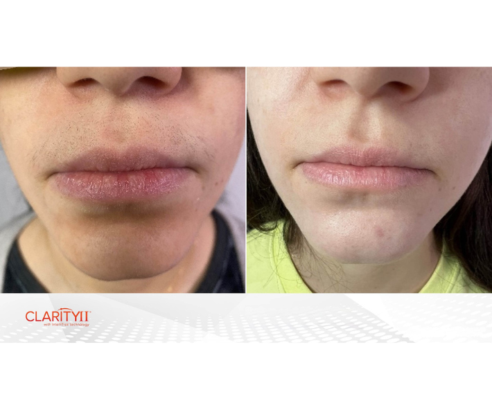Facial Hair Removal Before and After Revive Medical Spa Fayetteville Rogers