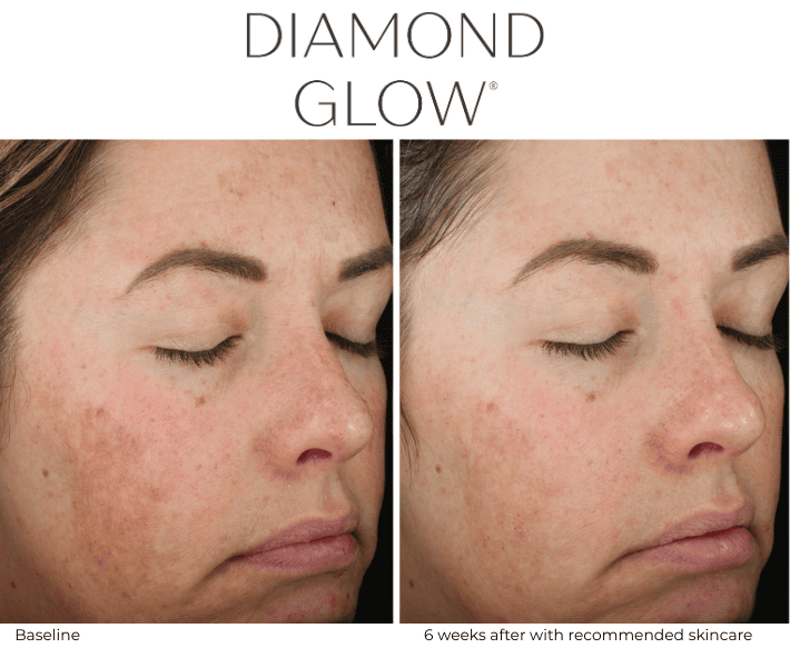 DiamondGlow Facials before and after Revive Medical Spa