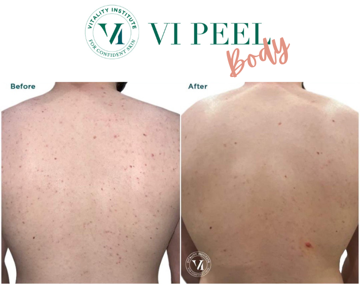 VI Peel Body Revive Medical Spa