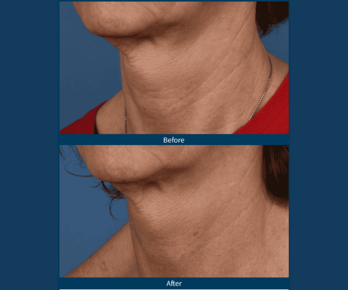 SkinPen Microneedling Before and After Revive Medical Spa