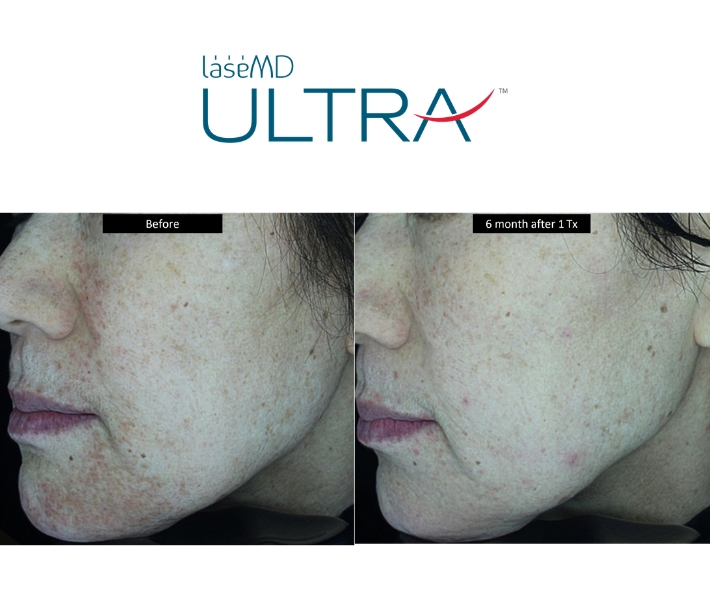 Ultra Laser Treatments Revive Medical Spa