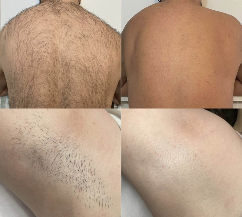 Laser Hair Removal Revive Medical Spa