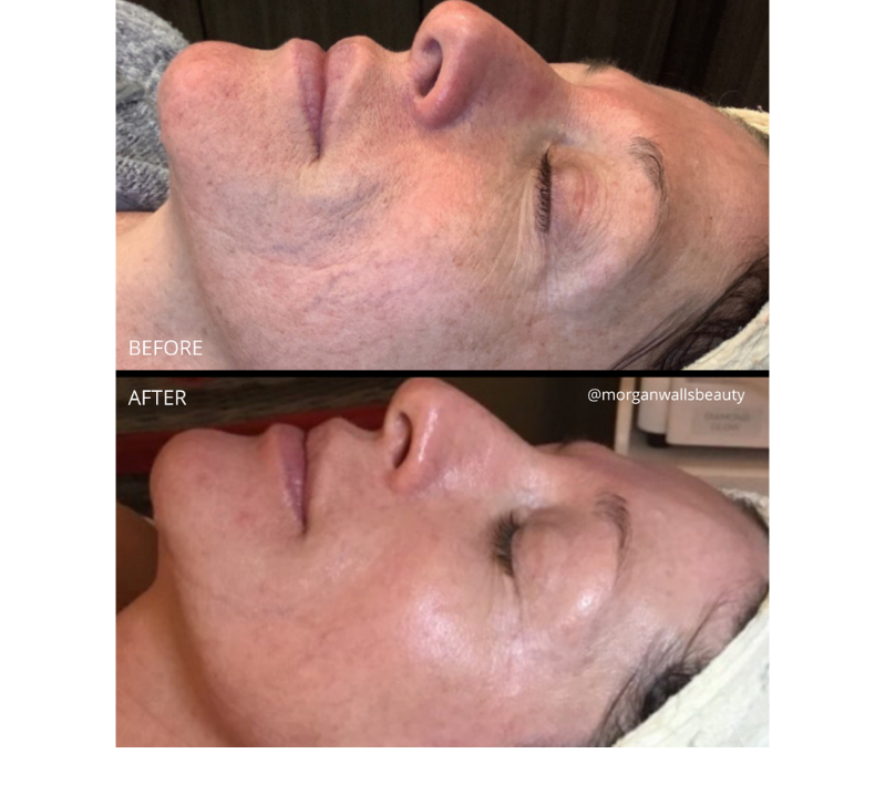Melanage Mini Revive Medical Spa