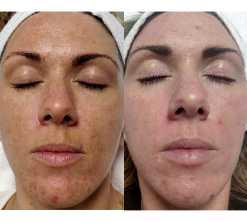Melanage Skin Brightening System Melanage Peel Revive Medical Spa