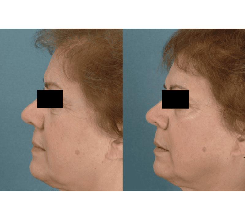 Pearl Before and After Revive Medical Spa Fayetteville
