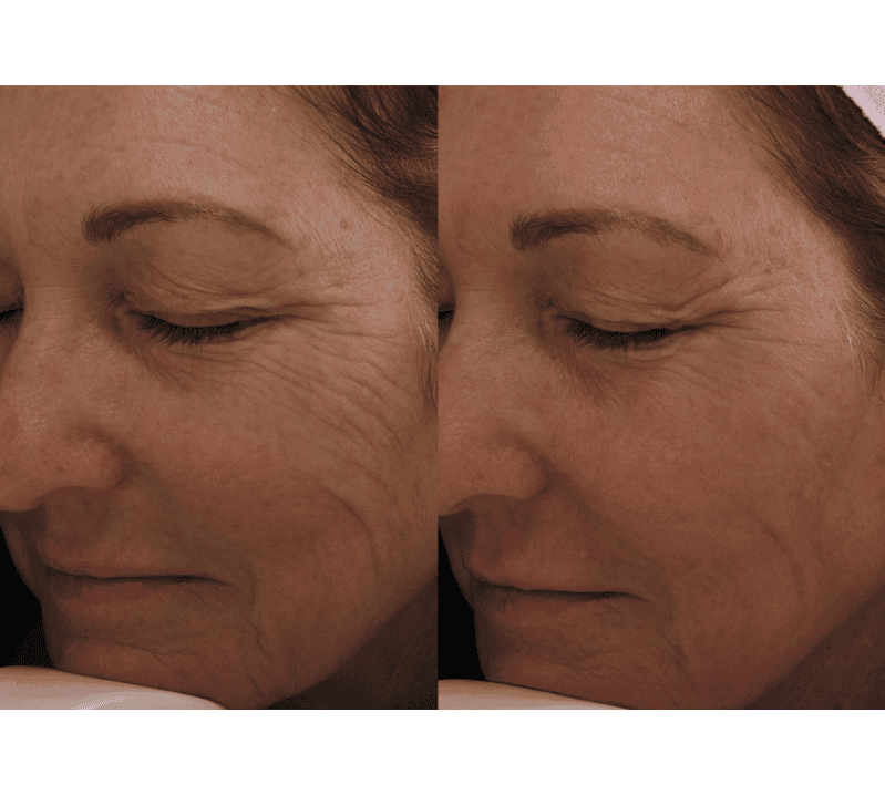 Pearl Fractional Before and After Revive Medical Spa Fayetteville