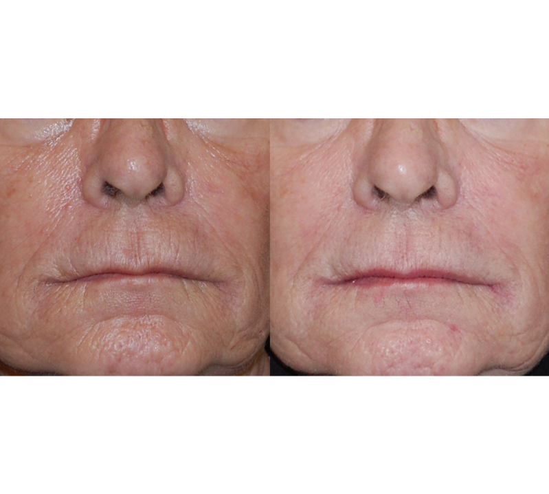 Pearl Fusion Before and After Revive Medical Spa Fayetteville