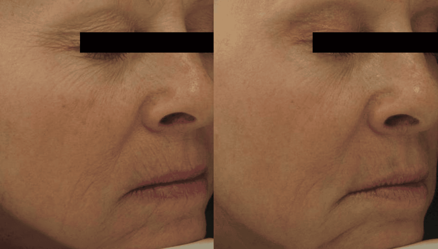 Pearl Fusion Before and After Revive Medical Spa Fayetteville