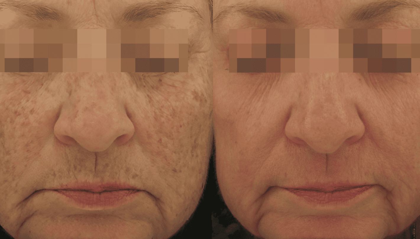 Pearl Fusion Before and After Revive Medical Spa Fayetteville
