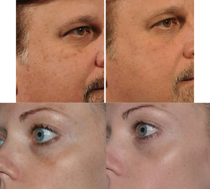 Pigment and sun damage laser treatments Revive Medical Spa