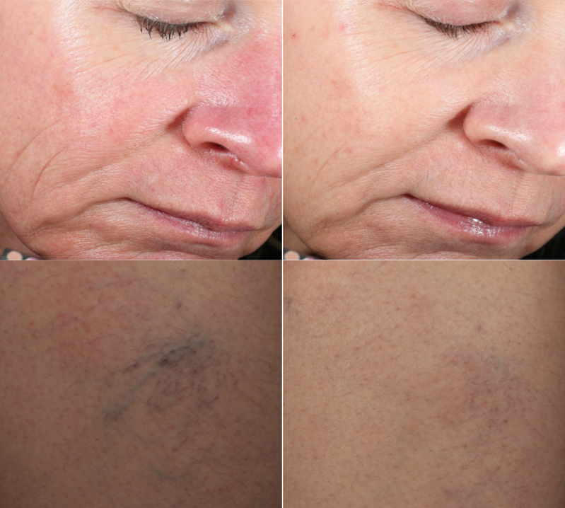 Redness Vascular Tone Before and after laser treatments Revive Medical Spa