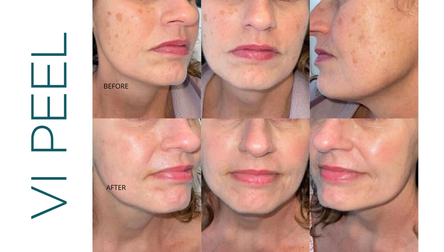 Chemical Peels Revive Medical Spa VI Peel Before and After