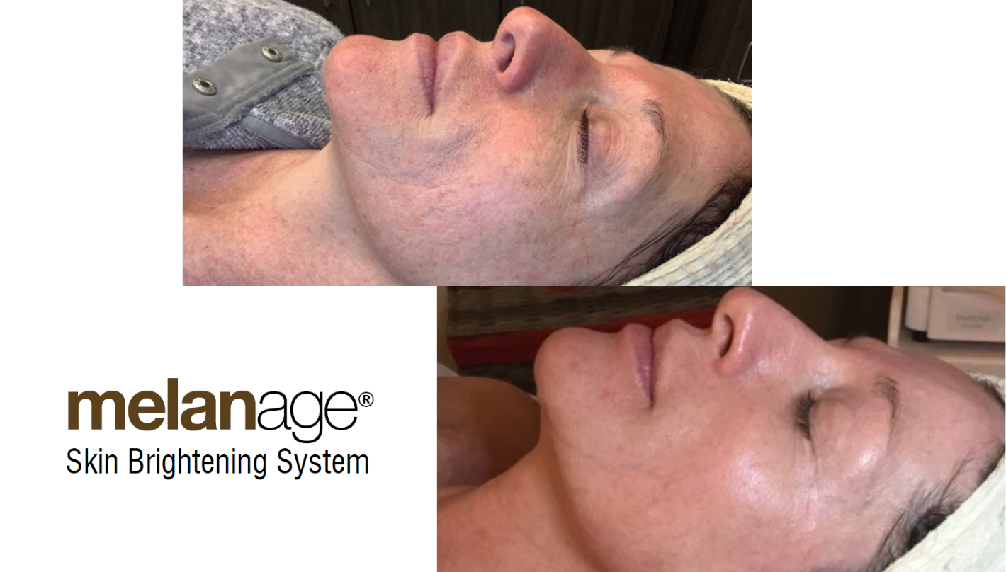 Chemical Peels Revive Medical Spa Melanage Peel Before and After