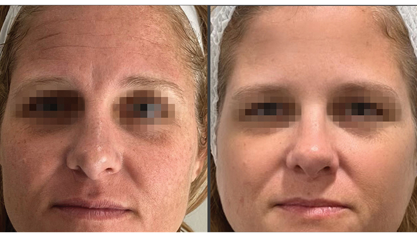 Ultra RF Laser Treatments in Northwest Arkansas Revive Medical Spa Before and After