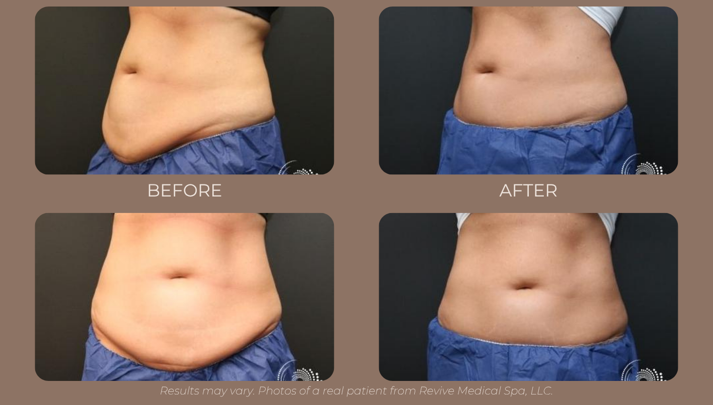 CoolSculpting Elite Revive Medical Spa Northwest Arkansas