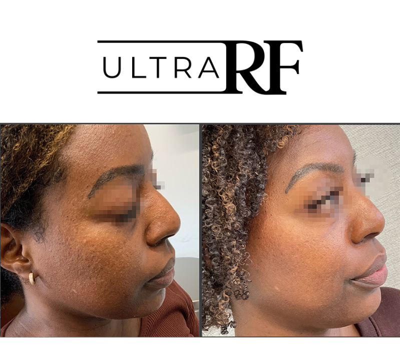 Ultra RF Comprehensive Rejuvenation Revive Medical Spa Before and after