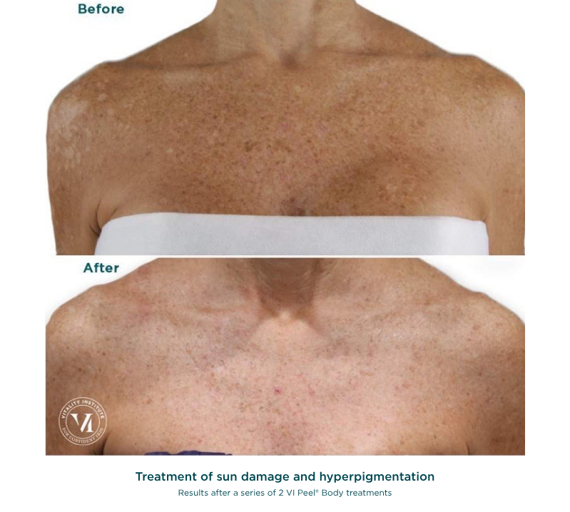 VI Peel Body Revive Medical Spa
