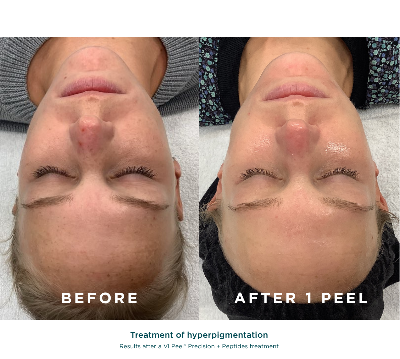 VI Peel Precision + Peptides Revive Medical Spa