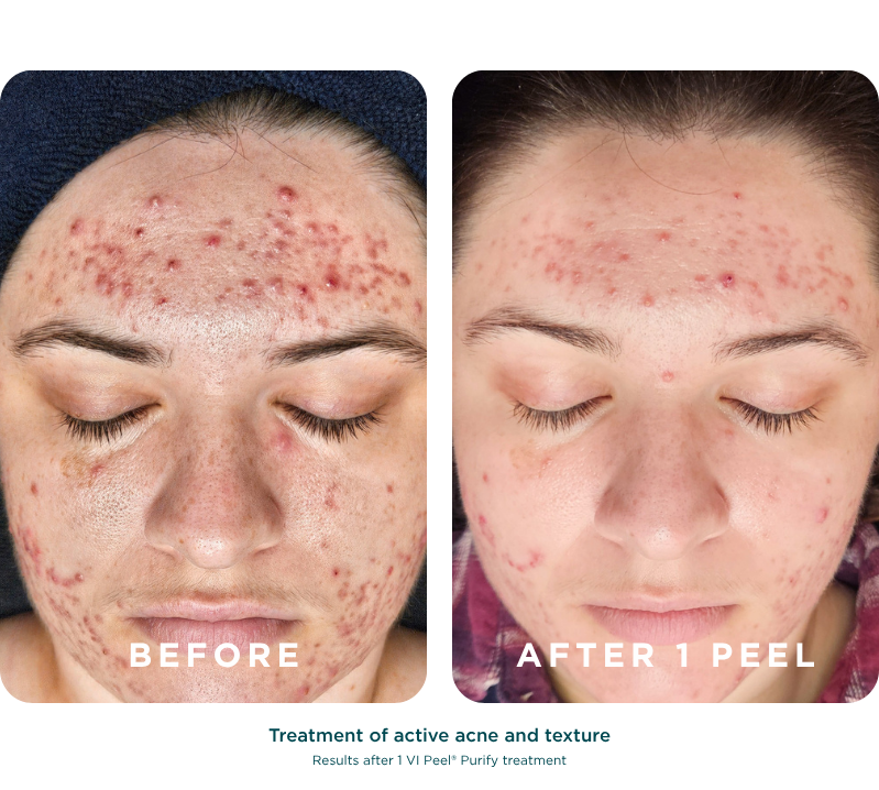 VI Peel Purify with Precision + Peptides Revive Medical Spa