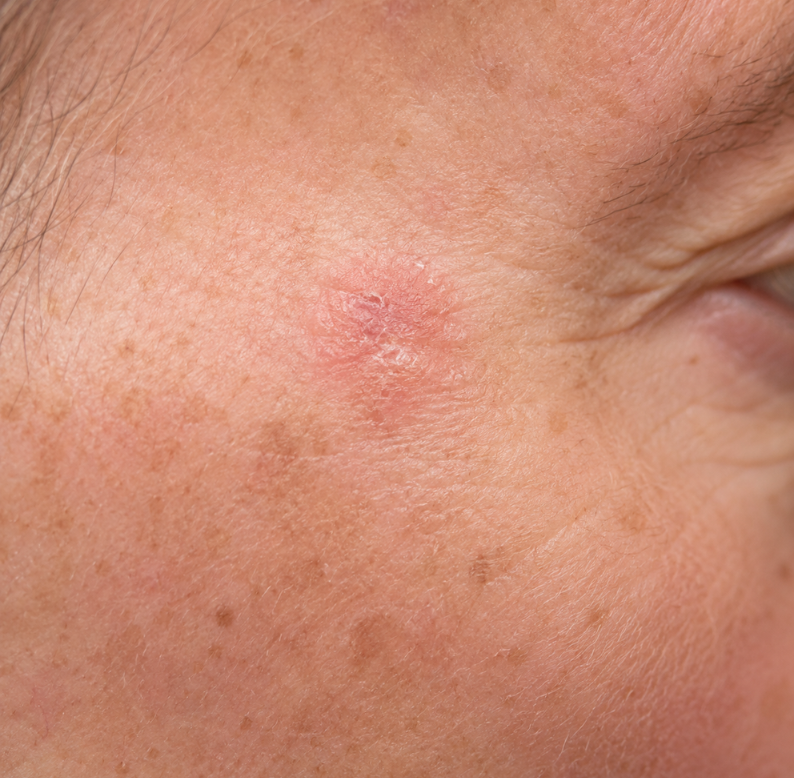 Actinic Keratosis Advanced Dermatology & Skin Cancer Center