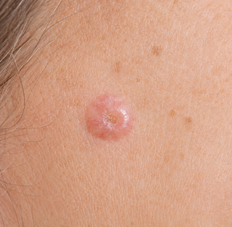 Basal Cell Carcinoma Advanced Dermatology & Skin Cancer Center