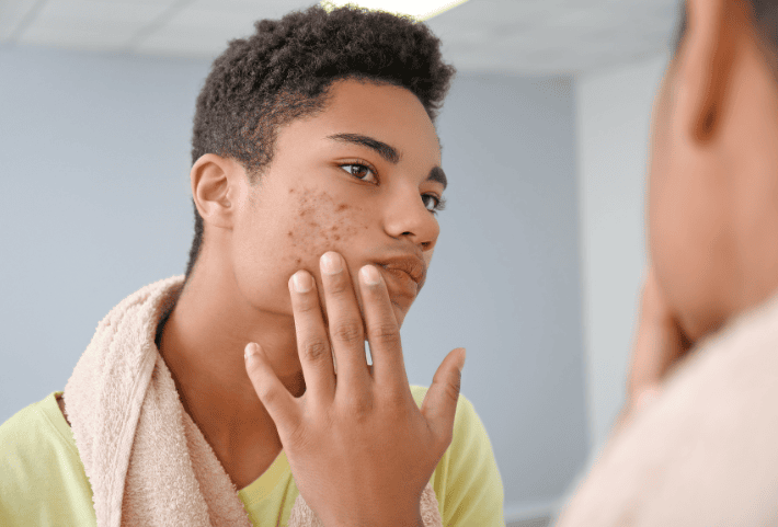 Advanced Dermatology & Skin Cancer Center Acne Treatment