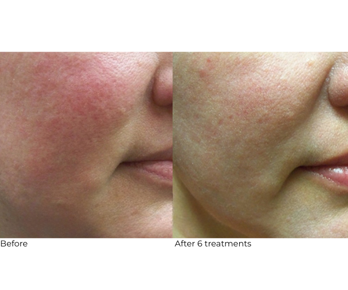 Laser Genesis Before and After Revive Medical Spa Fayetteville Rogers Harrison